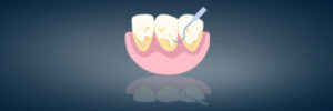 Periodontal