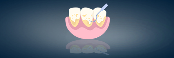 Periodontal