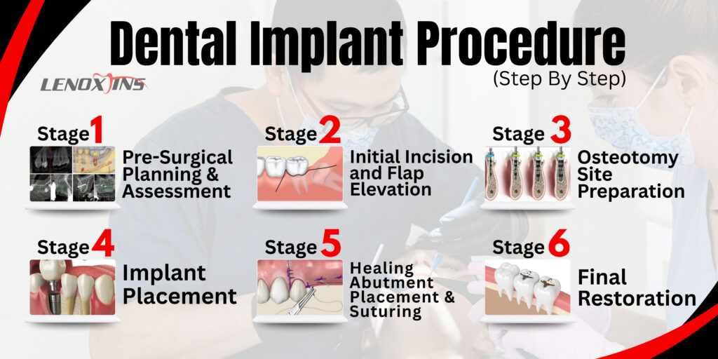 Step-by-Step Dental Implant Procedure – Key Tools Reviewed