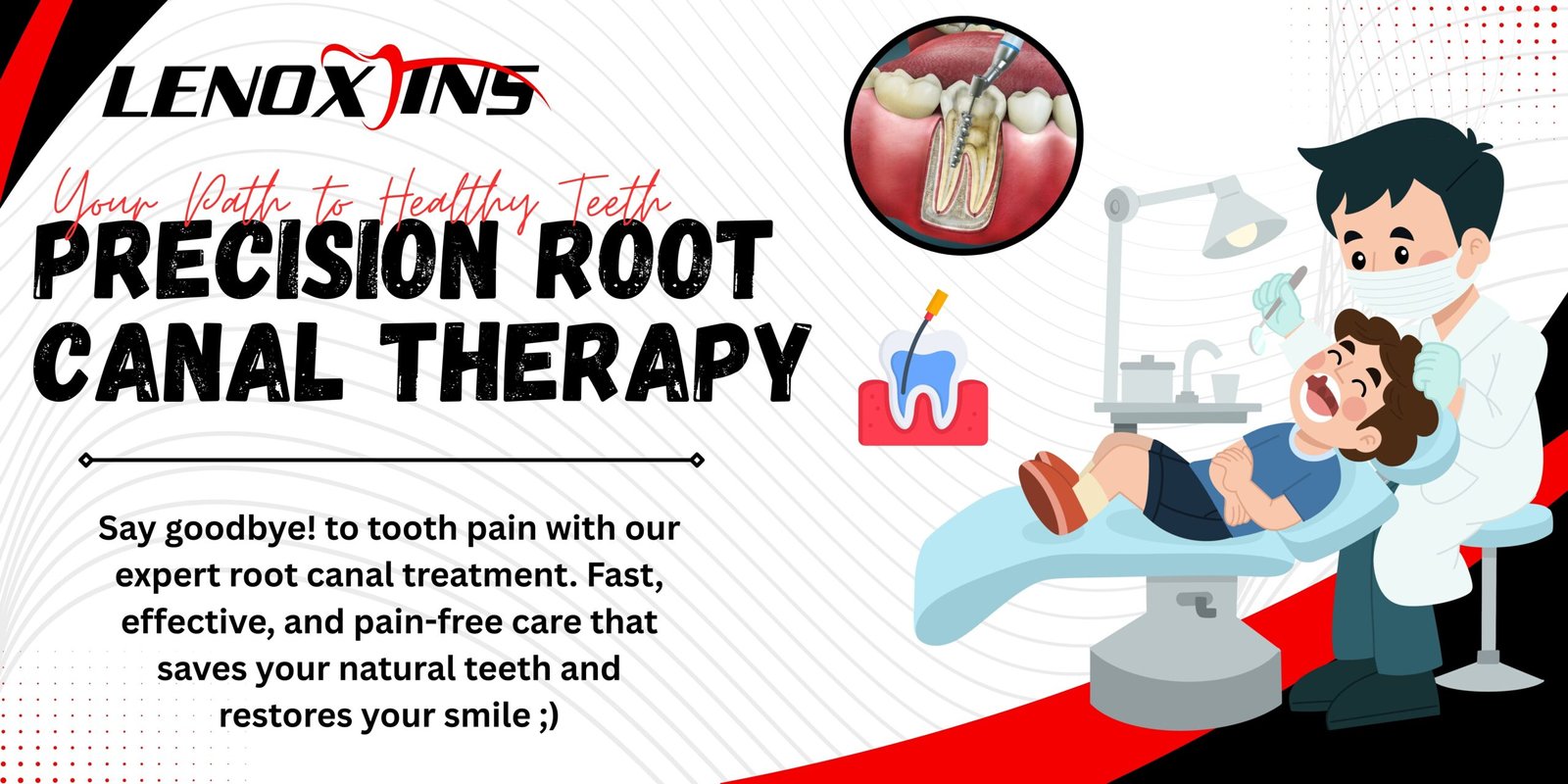Root canal treatment procedure showing dental instruments removing infected pulp from a tooth
