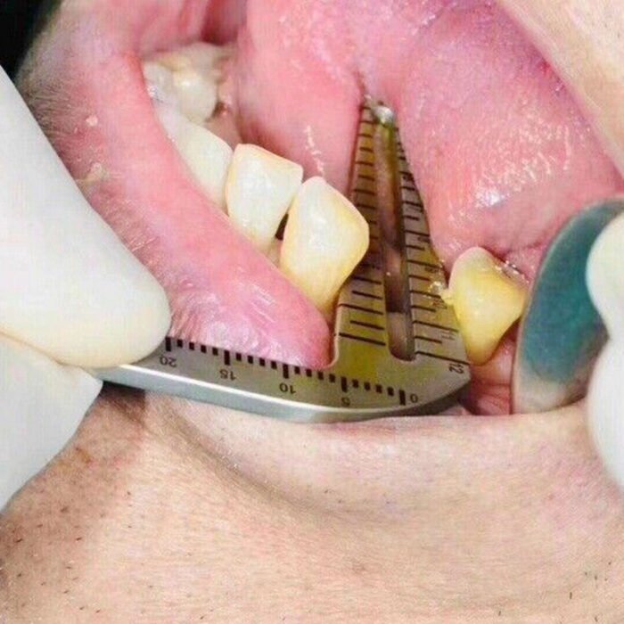 Set of Dental Implant Locator Depth Pin Gauge Guide - Image 6